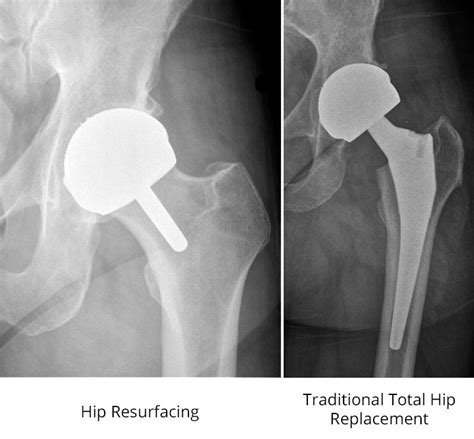 total hip resurfacing arthroplasty